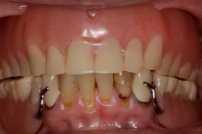 Before And After Dentures Seneca NE 69161
